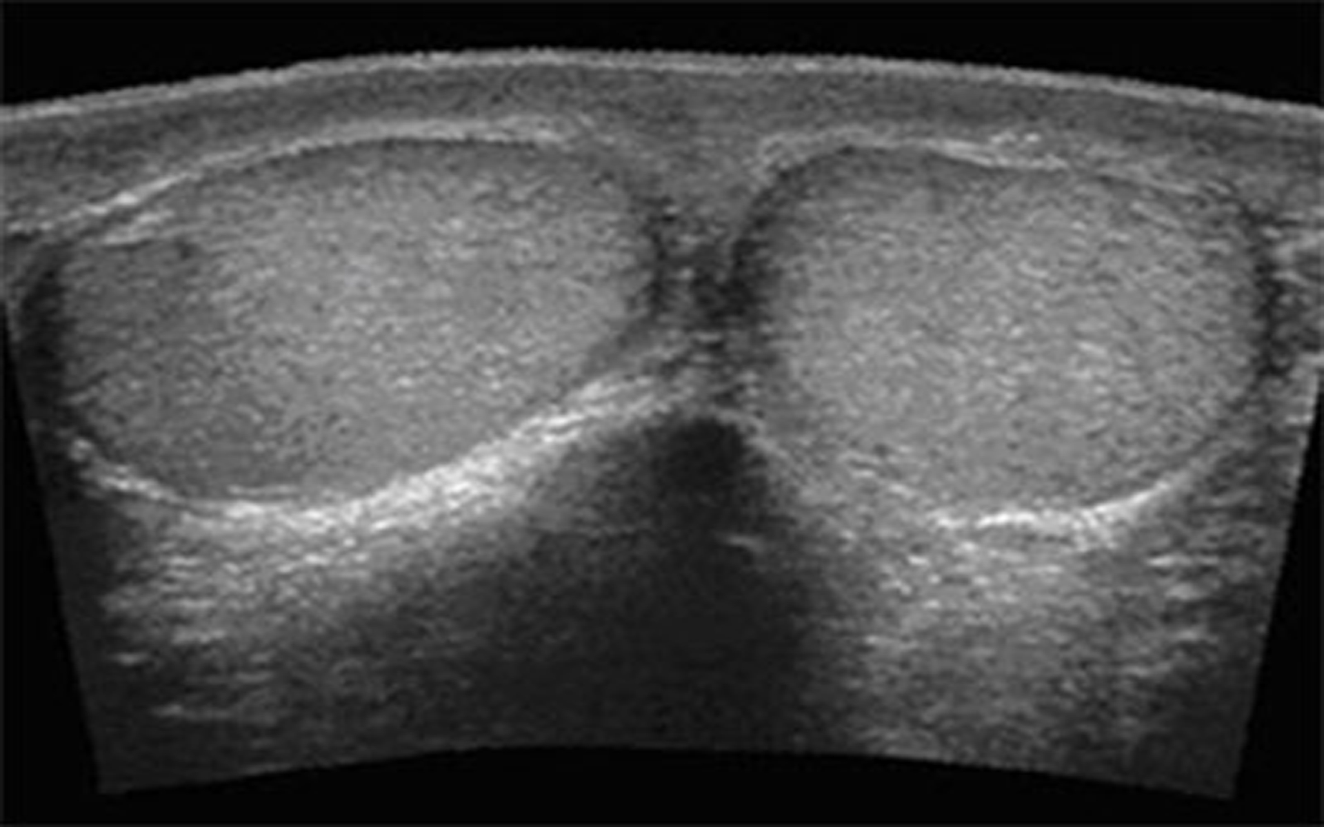 Узи яиц. Норма.УЗИ мошонки.яичек. Перекрут яичка УЗИ картина.