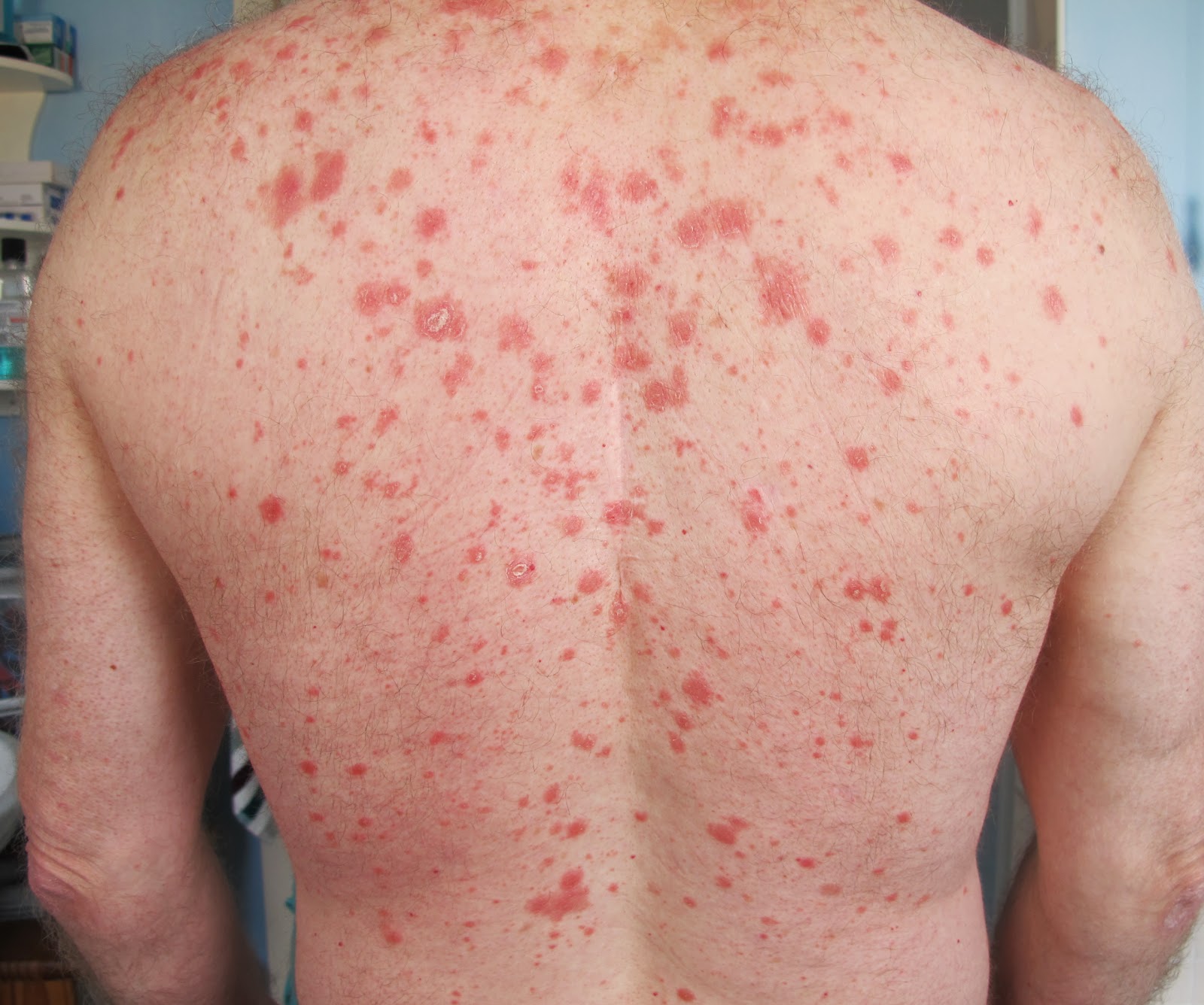 Pityriasis Rubra Pilaris Pathology